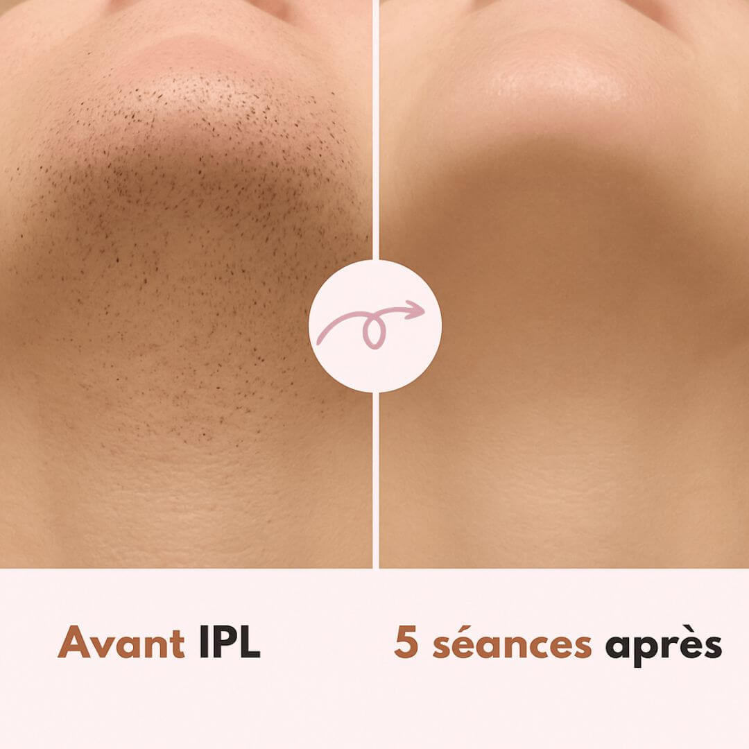 Épilateur à lumière pulsée ASTISKIN™