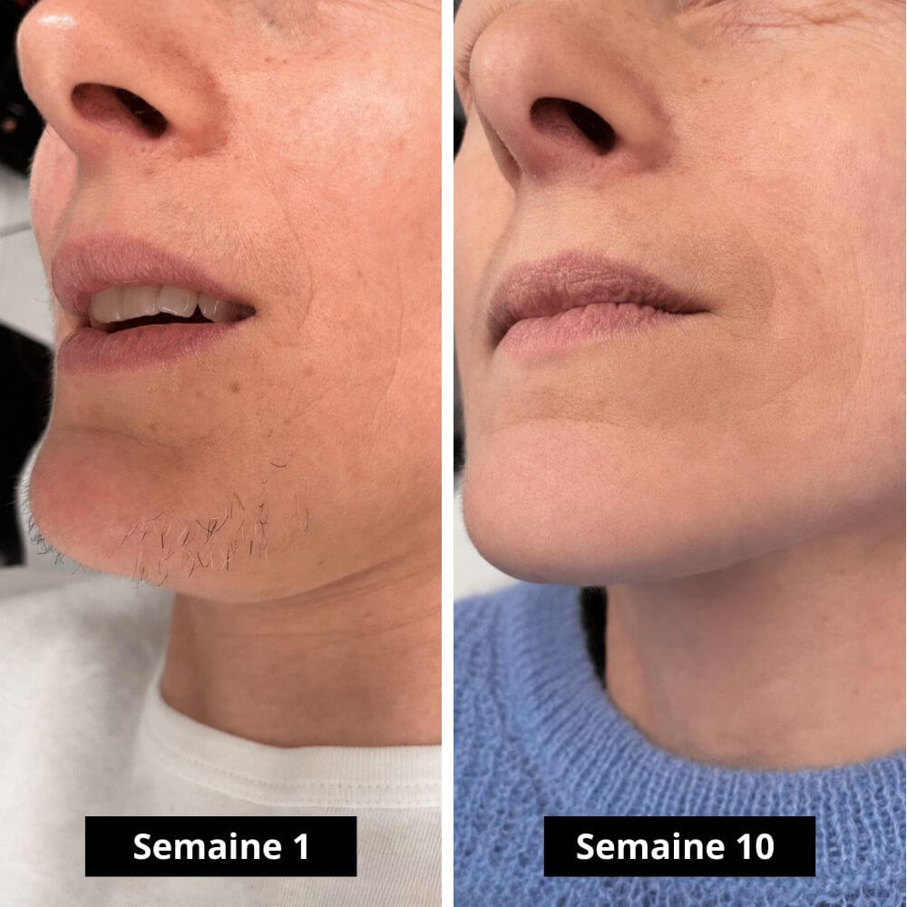 Épilateur à lumière pulsée ASTISKIN™